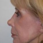 Laser Wrinkle Removal Before & After Patient #1873
