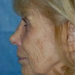 Laser Wrinkle Removal Before & After Patient #1873