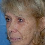 Laser Wrinkle Removal Before & After Patient #1872