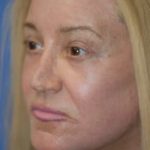 Laser Wrinkle Removal Before & After Patient #1871