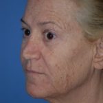 Laser Wrinkle Removal Before & After Patient #1871