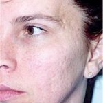 Laser Wrinkle Removal Before & After Patient #1870
