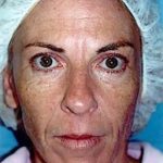 Laser Wrinkle Removal Before & After Patient #1869