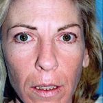 Laser Wrinkle Removal Before & After Patient #1869