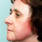Laser Wrinkle Removal Before & After Patient #1868