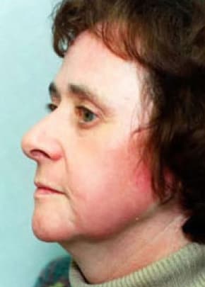 Laser Wrinkle Removal Before & After Patient #1868