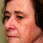 Laser Wrinkle Removal Before & After Patient #1868