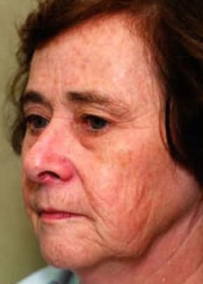 Laser Wrinkle Removal Before & After Patient #1868
