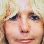 Laser Wrinkle Removal Before & After Patient #1867