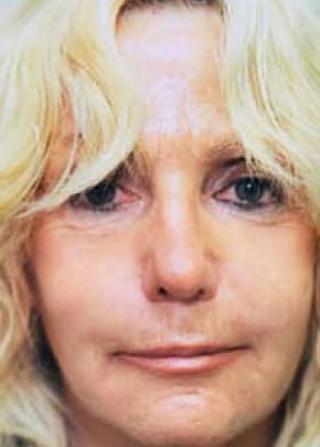 Laser Wrinkle Removal Before & After Patient #1867