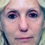 Laser Wrinkle Removal Before & After Patient #1867
