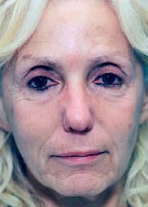 Laser Wrinkle Removal Before & After Patient #1867