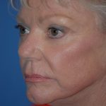 Laser Wrinkle Removal Before & After Patient #1866