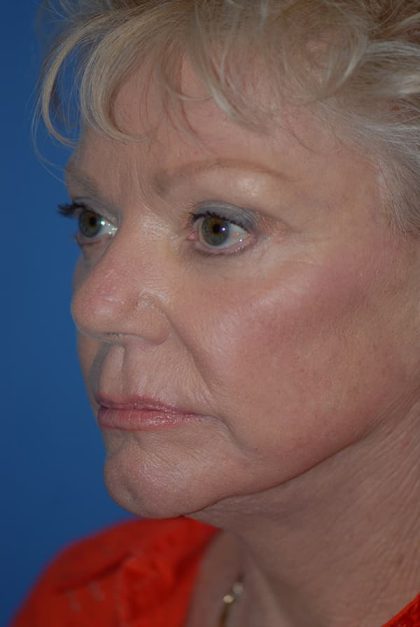 Laser Wrinkle Removal Before & After Patient #1866