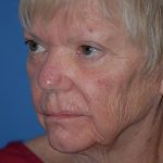 Laser Wrinkle Removal Before & After Patient #1866