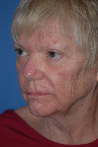 Laser Wrinkle Removal Before & After Patient #1866