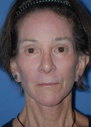Laser Wrinkle Removal Before & After Patient #1845