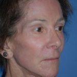 Laser Wrinkle Removal Before & After Patient #1845
