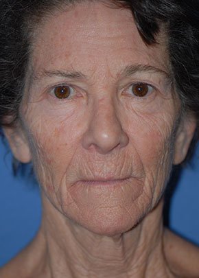 Laser Wrinkle Removal Before & After Patient #1845