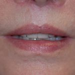 Lip Enhancement Before & After Patient #2006