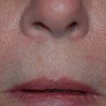 Lip Enhancement Before & After Patient #2006