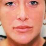 Lip Enhancement Before & After Patient #2004