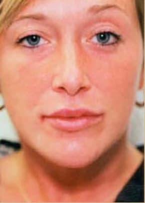 Lip Enhancement Before & After Patient #2004