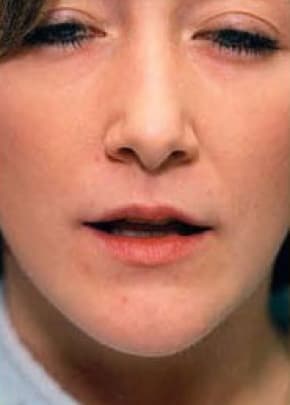 Lip Enhancement Before & After Patient #2004