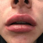 Lip Enhancement Before & After Patient #2003