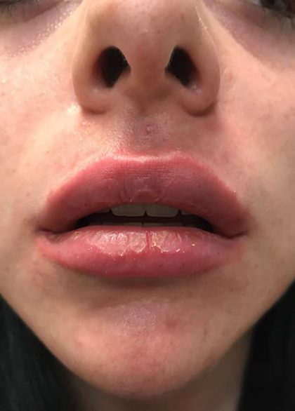 Lip Enhancement Before & After Patient #2003