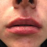 Lip Enhancement Before & After Patient #2003