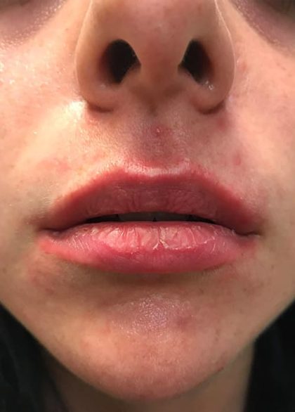 Lip Enhancement Before & After Patient #2003
