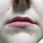 Lip Enhancement Before & After Patient #2002