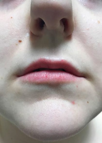 Lip Enhancement Before & After Patient #2002