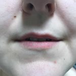 Lip Enhancement Before & After Patient #2002