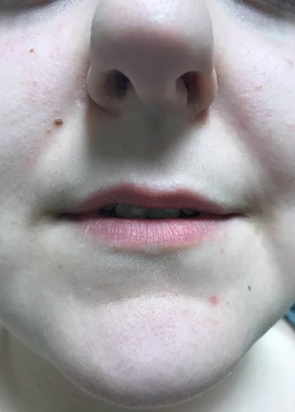 Lip Enhancement Before & After Patient #2002