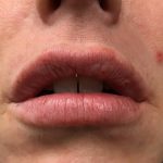 Lip Enhancement Before & After Patient #2001