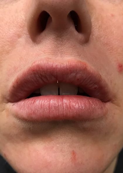 Lip Enhancement Before & After Patient #2001