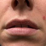 Lip Enhancement Before & After Patient #2001