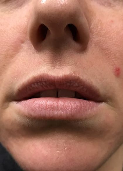Lip Enhancement Before & After Patient #2001