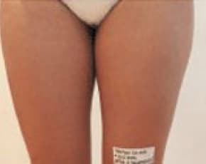 Mesotherapy Before & After Patient #2505