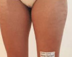 Mesotherapy Before & After Patient #2505
