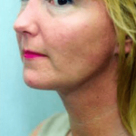 Necklipo Before & After Patient #2064