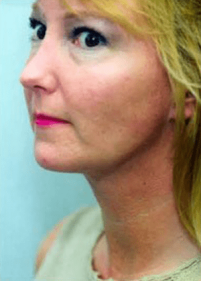 Necklipo Before & After Patient #2064