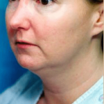 Necklipo Before & After Patient #2064