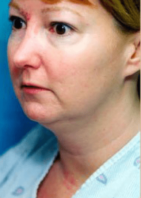 Necklipo Before & After Patient #2064