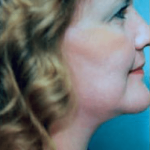 Necklipo Before & After Patient #2063