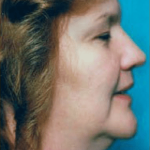 Necklipo Before & After Patient #2063