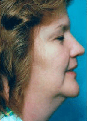 Necklipo Before & After Patient #2063