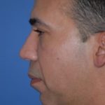Necklipo Before & After Patient #2061